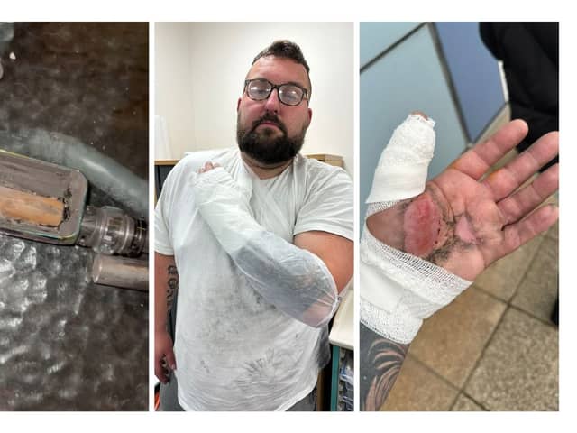 A lorry driver suffered horror injuries when an e-cigarette exploded in his hand.
Mike Calver, 38, was changing the battery on his device at home in Stoke-on-Trent, when it blew up.
His hand, beard and clothes were set on fire - while the scalding e-cigarette stuck to his hand.