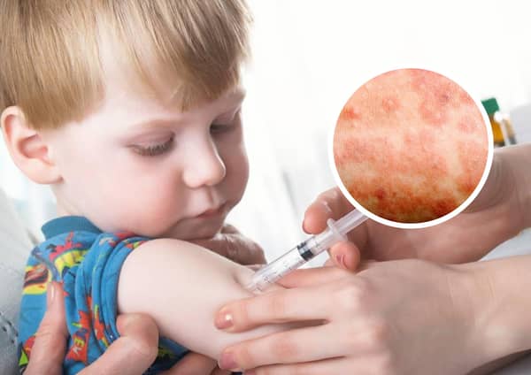 Measles cases are on the rise - and health officials fear many children are not vaccinated against it. (Picture: RCPCH and NHS)