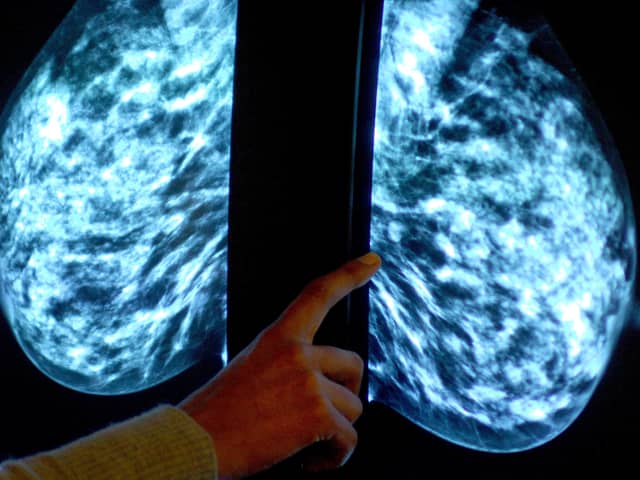 Breast screening uptake in Greater Preston remains below pre-pandemic levels, new figures show