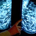 Breast screening uptake in Greater Preston remains below pre-pandemic levels, new figures show