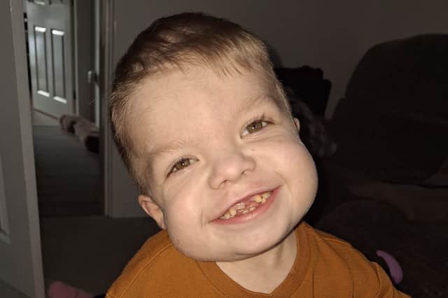 Shaemus Flood (pictured) was born with Jeune’s syndrome, a form of congenital dwarfism which causes deformities in the chest.