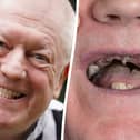 Ex-miner celebrates getting new teeth after living on diet of soup and painkillers