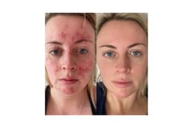 Customers share amazing before and after results of skincare brand that took the world by storm - Abigail's results 47 Skin 