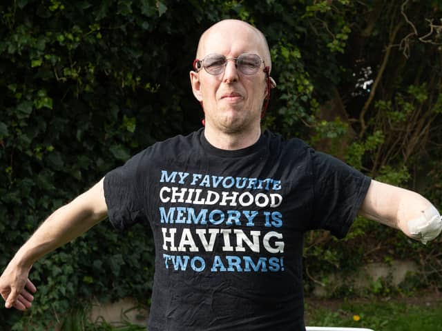 Mark Daniel was attacked by a dog in Knott End a year ago and lost his arm, but says he forgives the dog owner and wants to move on. Photo: Lucinda Herbert