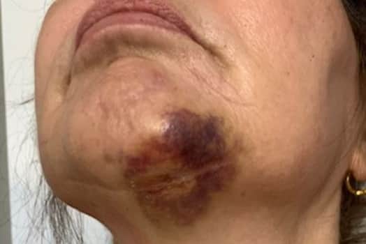A Lancashire grandmother has received £23,000 in damages from package holiday company On The Beach after she sustained significant injuries from a headfirst fall along a “poorly lit and badly surfaced” pathway on her first night on holiday in Fuerteventura.