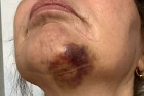 A Lancashire grandmother has received £23,000 in damages from package holiday company On The Beach after she sustained significant injuries from a headfirst fall along a “poorly lit and badly surfaced” pathway on her first night on holiday in Fuerteventura.