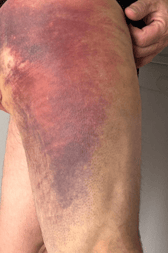 The police officer suffered extensive bruising but was back on duty the following day.