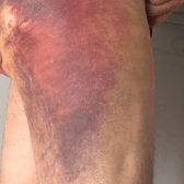 The police officer suffered extensive bruising but was back on duty the following day.