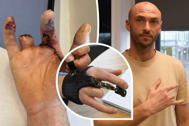 A young dad has been awarded a "seven figure" payout after his life was ruined by a horrific workplace saw accident - that left him with two missing fingers.