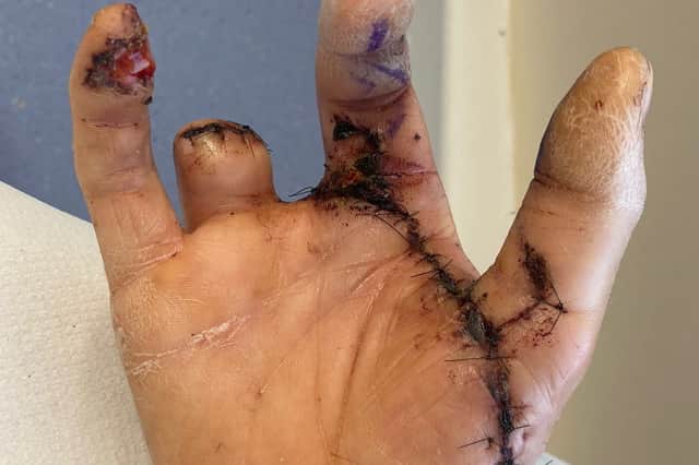 Chris Pawson's hand following the workplace accident that left him with two missing fingers. // A young dad has been awarded a "seven figure" pay out after his life was ruined by a horrific workplace saw accident - that left him with two missing fingers.  Chris Pawson, 38, had a successful career as a self-employed joiner working on makeovers for some of the UKÕs best-known high street food chains. But his life changed forever when his right hand was dragged into a lethal spinning blade after a colleague failed to set up a saw properly. His middle finger disappeared completely and his ring finger was partially amputated while his thumb and index finger were left with extensive nerve, muscle and tendon damage.