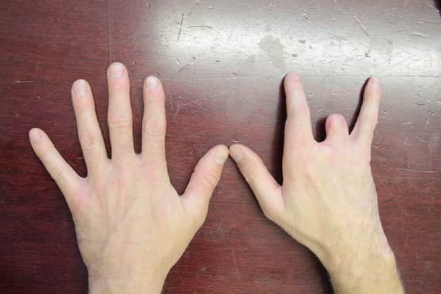 Chris Pawson's hand following the workplace accident that left him with two missing fingers. // A young dad has been awarded a "seven figure" pay out after his life was ruined by a horrific workplace saw accident - that left him with two missing fingers.  Chris Pawson, 38, had a successful career as a self-employed joiner working on makeovers for some of the UKÕs best-known high street food chains. But his life changed forever when his right hand was dragged into a lethal spinning blade after a colleague failed to set up a saw properly. His middle finger disappeared completely and his ring finger was partially amputated while his thumb and index finger were left with extensive nerve, muscle and tendon damage.