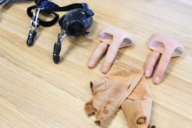 Chris Pawson's prosthetics. // A young dad has been awarded a "seven figure" pay out after his life was ruined by a horrific workplace saw accident - that left him with two missing fingers.  Chris Pawson, 38, had a successful career as a self-employed joiner working on makeovers for some of the UK’s best-known high street food chains. But his life changed forever when his right hand was dragged into a lethal spinning blade after a colleague failed to set up a saw properly. His middle finger disappeared completely and his ring finger was partially amputated while his thumb and index finger were left with extensive nerve, muscle and tendon damage.