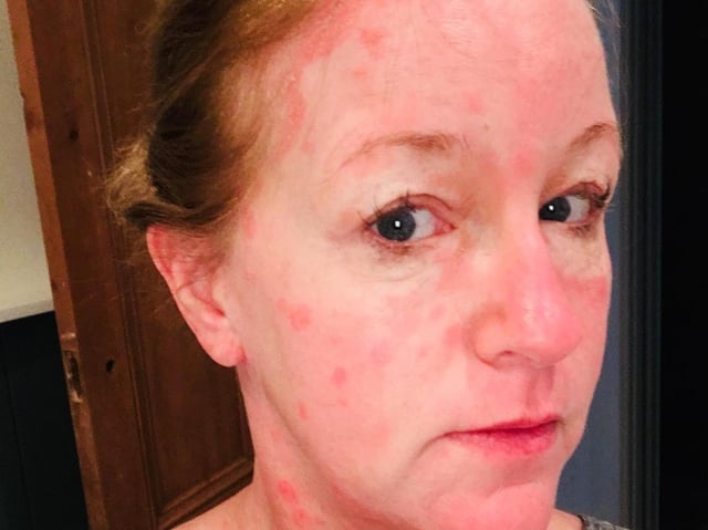 Paula Taylor when she had severe psoriasis