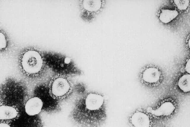 According to the CDC the virus that causes Severe Acute Respiratory Syndrome (SARS) might be a "previously unrecognized virus from the Coronavirus family." (Photo by CDC/Getty Images)