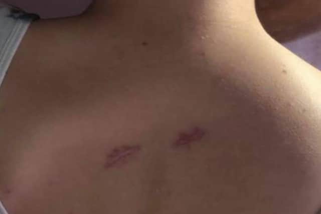Eve Hewitson-Cross has been left with lifelong scars