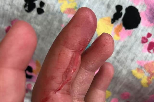 Honour's injury after a springer spaniel bit her middle finger.