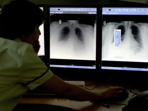 Public Health England figures show there were 14.8 cases of TB annually for every 100,000 people in Preston between 2017 and 2019