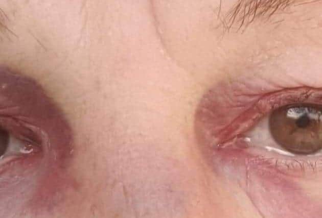 The woman's black eye