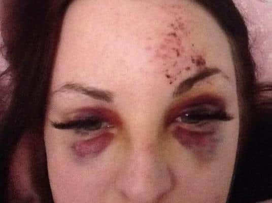 Andrea was left with black eyes after a seizure
