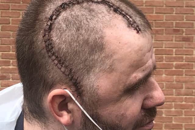 Lee shows the scar left after his surgery