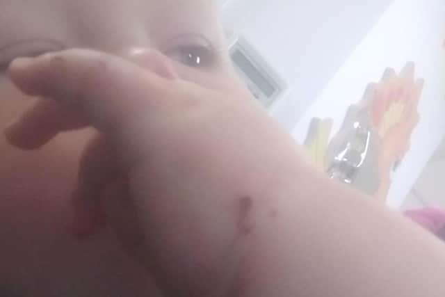 Some of the injuries on Rowan's hand
