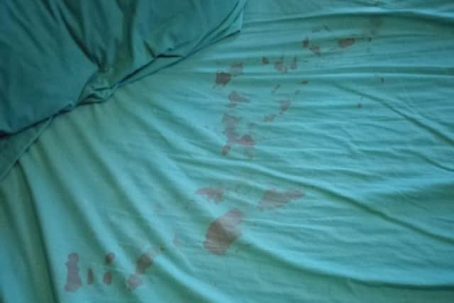The bloodstained bedclothes