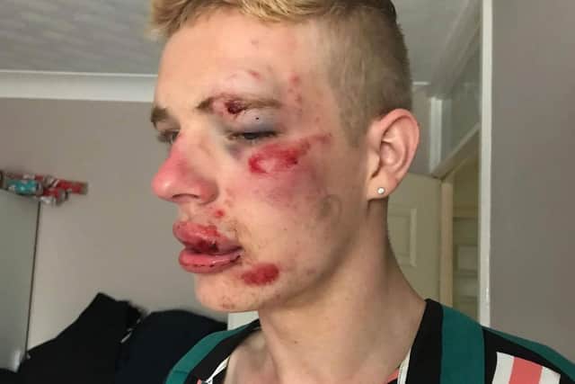 Ryan was left with horrific injuries and struggling to come to terms with the attack