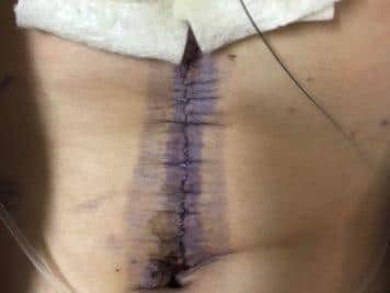 Sam’s scar after the surgery to remove the tumour near his kidney