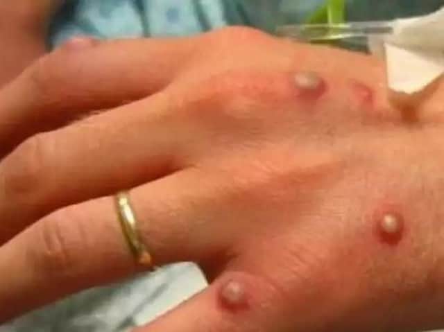 A number of cases of monkeypox have been confirmed in the UK.