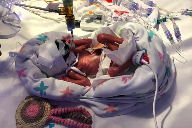 Baby Stella was born more than four months premature