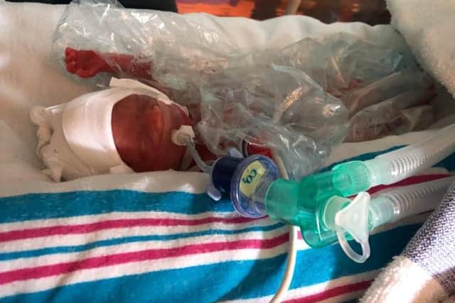 Stella was born at just 22 weeks and spent 5 months in an incubator