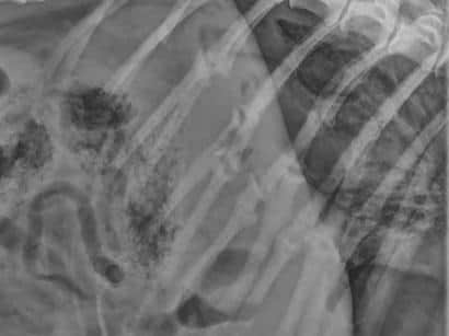An x-ray of some of the rib fractures suffered by Bonzo, a grey crossbreed. Bonzo died after being attacked by his owner, Andrew MacKay, who lived at Clarence Avenue, Knott-End-On-Sea, Poulton-Le-Fylde, Lancashire, but has since moved to Livingston, West Lothian. MacKay was jailed for 18 weeks after being found guilty of four animal welfare charges