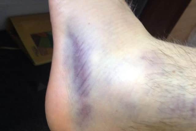Danny's foot was broken in the incident and he will spent up to 10 weeks on crutches