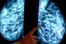 More than 35,000 women miss vital breast cancer screenings in Lancashire