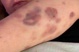 Her body is also covered with bruising from the seizures, when her arms and legs began jerking uncontrollably in frantic spasms