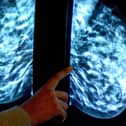 Breast screening