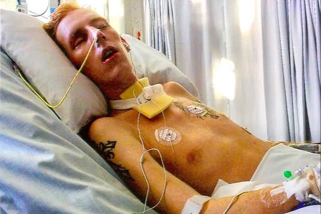 Anthony spent five weeks in an induced coma after the explosion.
