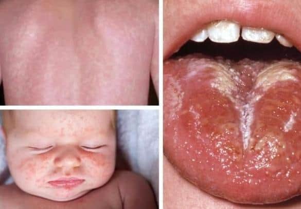 The symptoms of scarlet fever as cases are reported in Lancashire