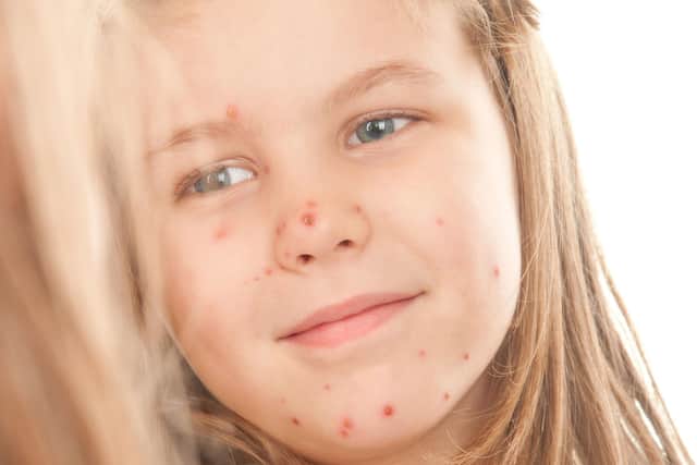 A Generic Photo of a girl suffering from chicken pox. Credit: PA