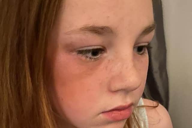 11-year-old Ellissia was stamped on, kicked and punched by a gang of youths