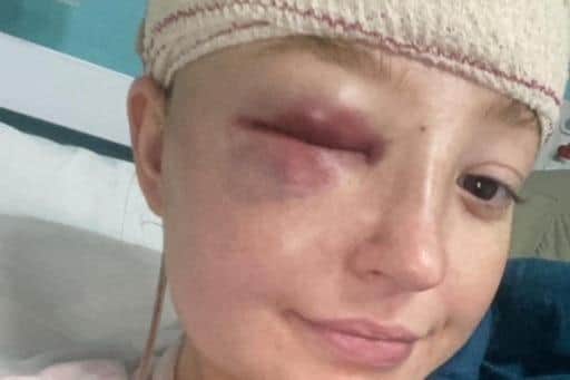 Courtney Laird pictured after her operation to remove a brain tumour