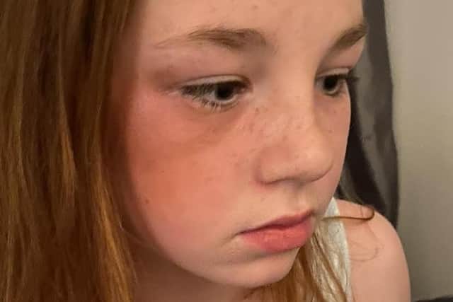 11-year-old Ellissia Brooks after being beaten by a gang of youths