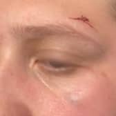 Lucy O'Connor, 22, from Preston was robbed of her new phone and cash last week when she suffered a seizure, cutting her face during her fall