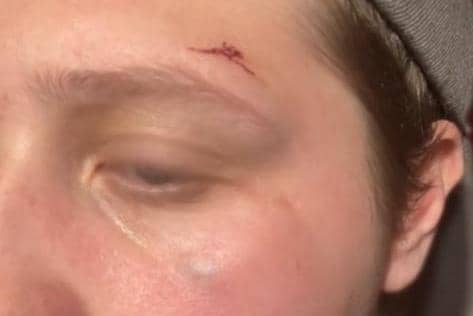 Lucy O'Connor, 22, from Preston was robbed of her new phone and cash last week when she suffered a seizure, cutting her face during her fall