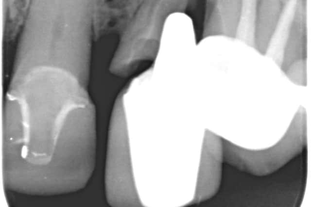 A dental X-ray shows a failed root canal and post crown in the upper left canine