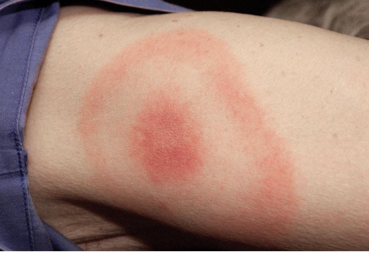 Here's what the council have said about a suspected tick outbreak in a kids play park