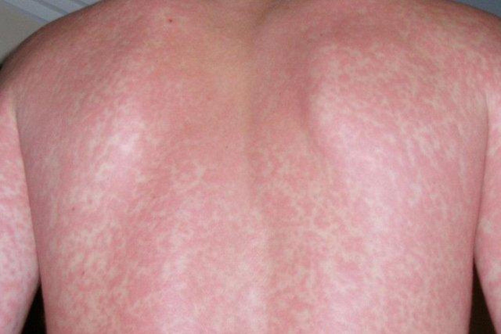 Children receiving treatment after scarlet fever outbreak at a Lancashire nursery