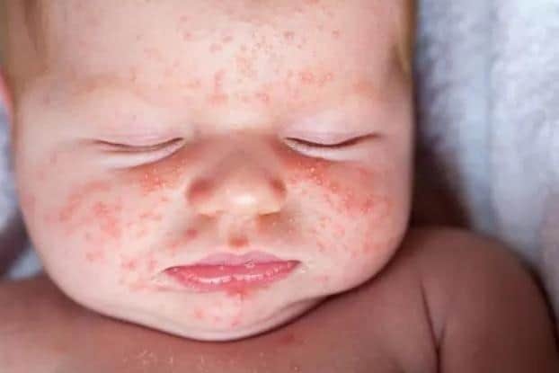 Scarlet fever