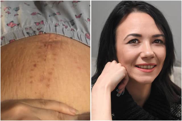 Sarah is currently in remission for ovarian cancer. Left: Sarah's stomach now.