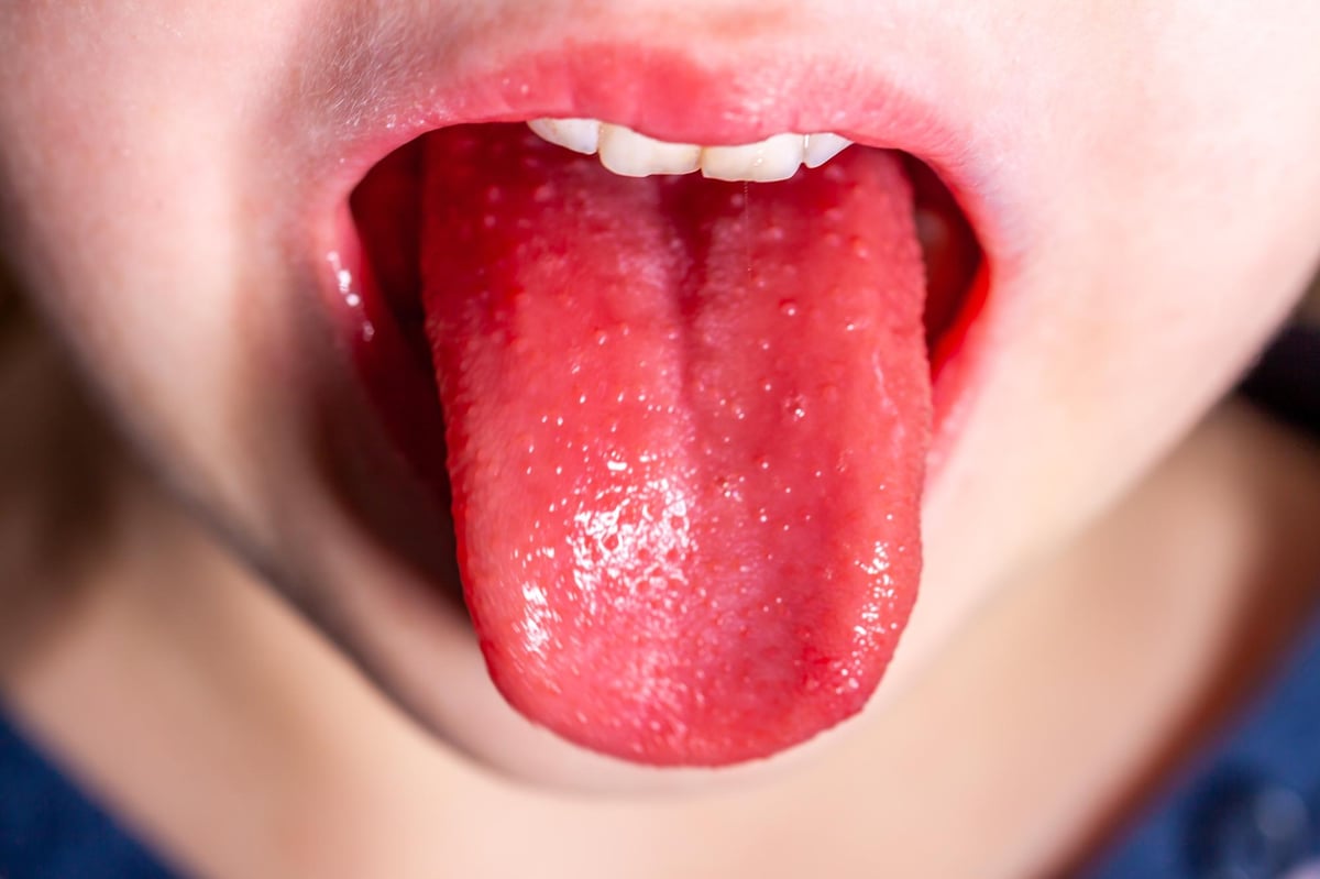 How many cases of scarlet fever have been reported in each area of Lancashire